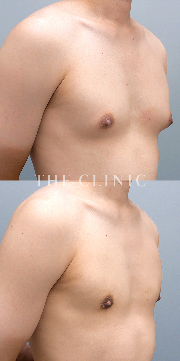 真性女性化乳房の女性化乳房治療(男性の胸の膨らみ改善)（23歳男性）の術前・術後写真