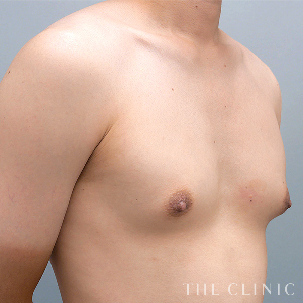 真性女性化乳房の女性化乳房治療(男性の胸の膨らみ改善)（23歳男性）の術前写真