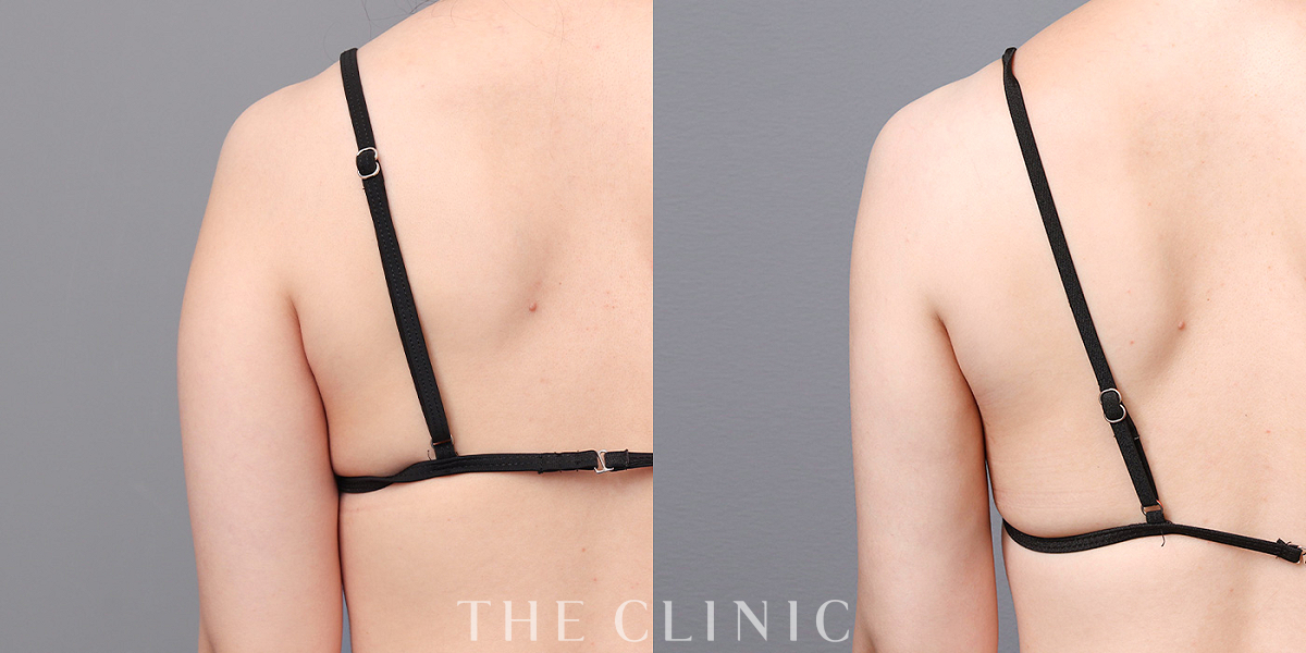 ベイザー脂肪吸引の術前/術後