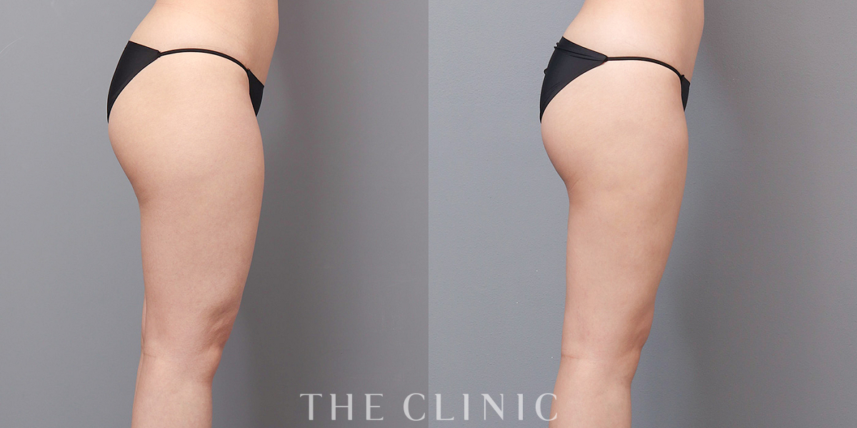 ベイザー脂肪吸引の術前/術後