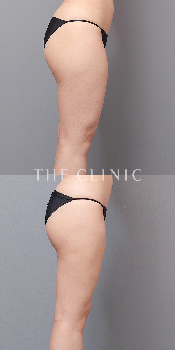 太もものベイザー脂肪吸引（26歳女性）の術前・術後写真