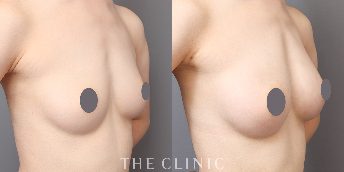 コンデンスリッチ豊胸の術前/術後