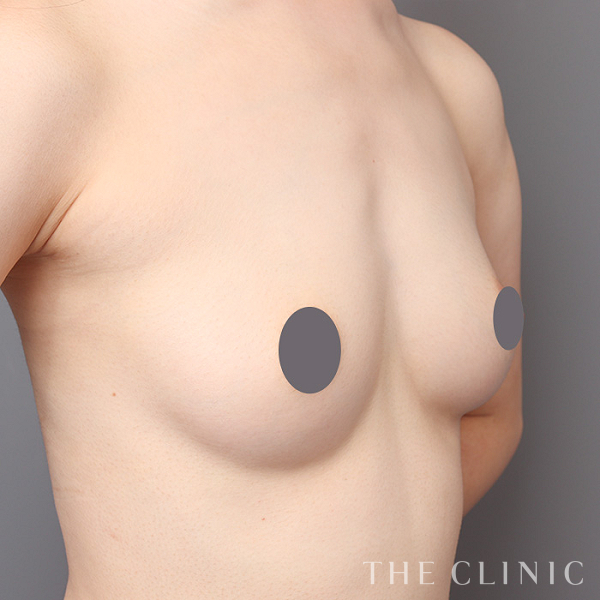 ボリュームアップのコンデンスリッチ豊胸（27歳女性）の術前写真