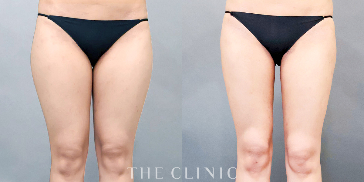 ベイザー脂肪吸引の術前/術後