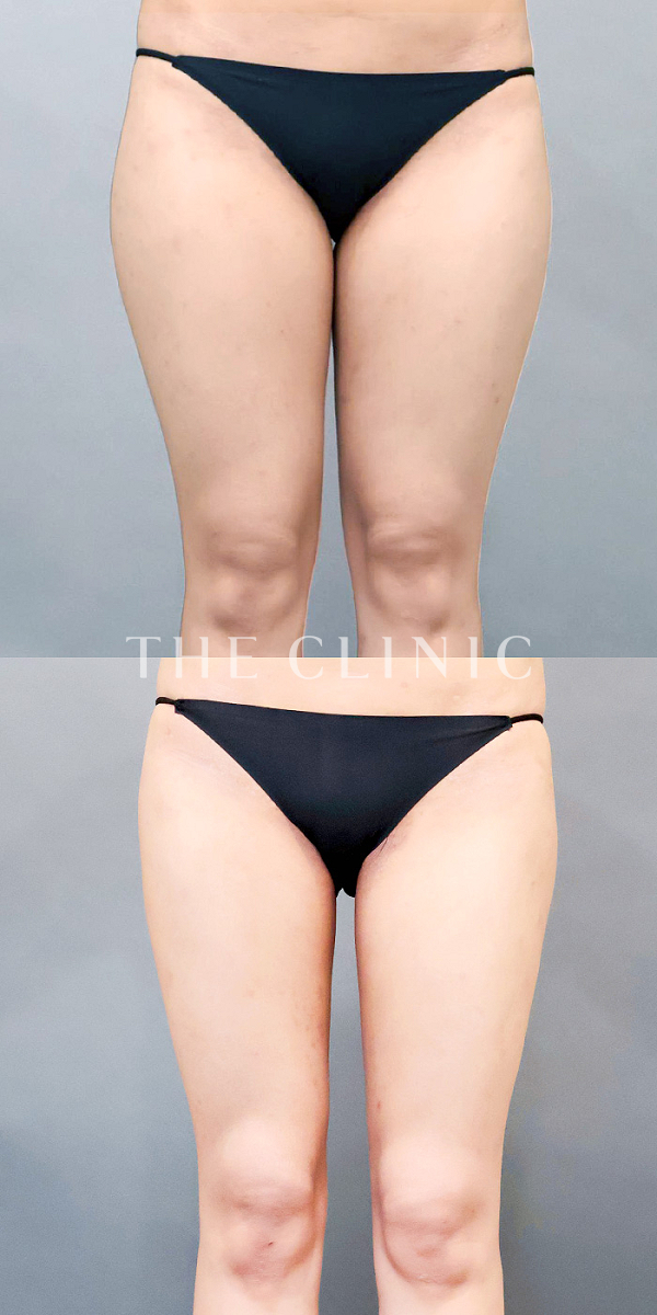 太もものベイザー脂肪吸引（25歳女性）の術前・術後写真