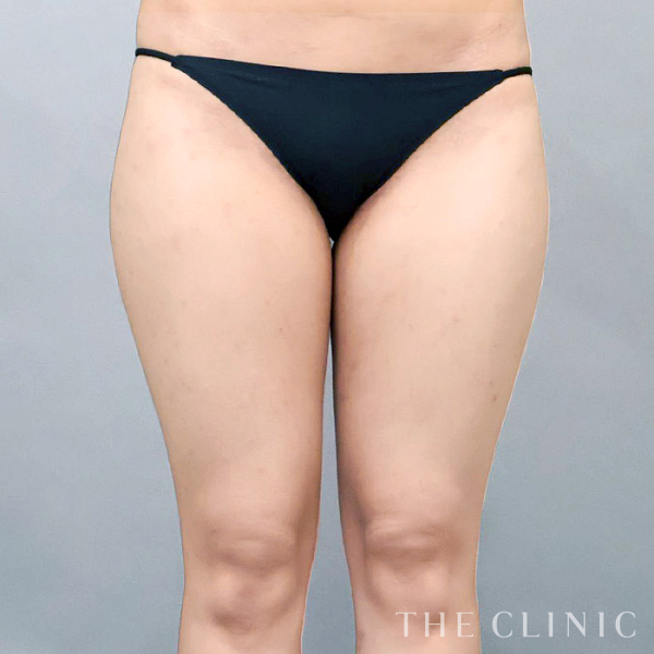 太もものベイザー脂肪吸引（25歳女性）の術前写真