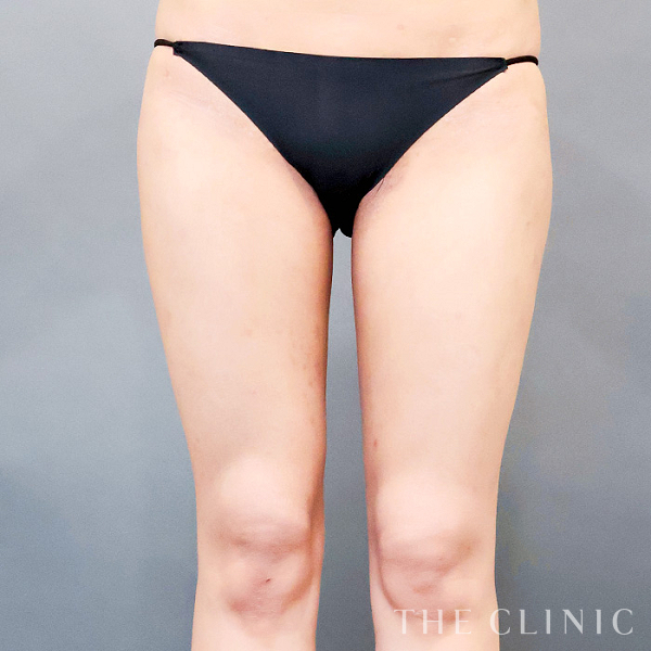 太もものベイザー脂肪吸引（25歳女性）の術後写真