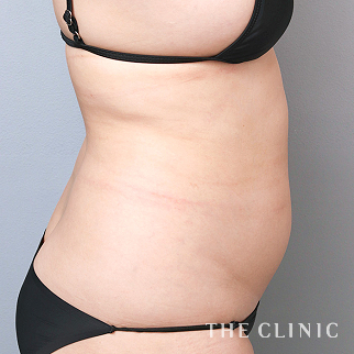 【THE CLINIC 症例画像】No.1545_1_腰・ウエスト_360脂肪吸引®