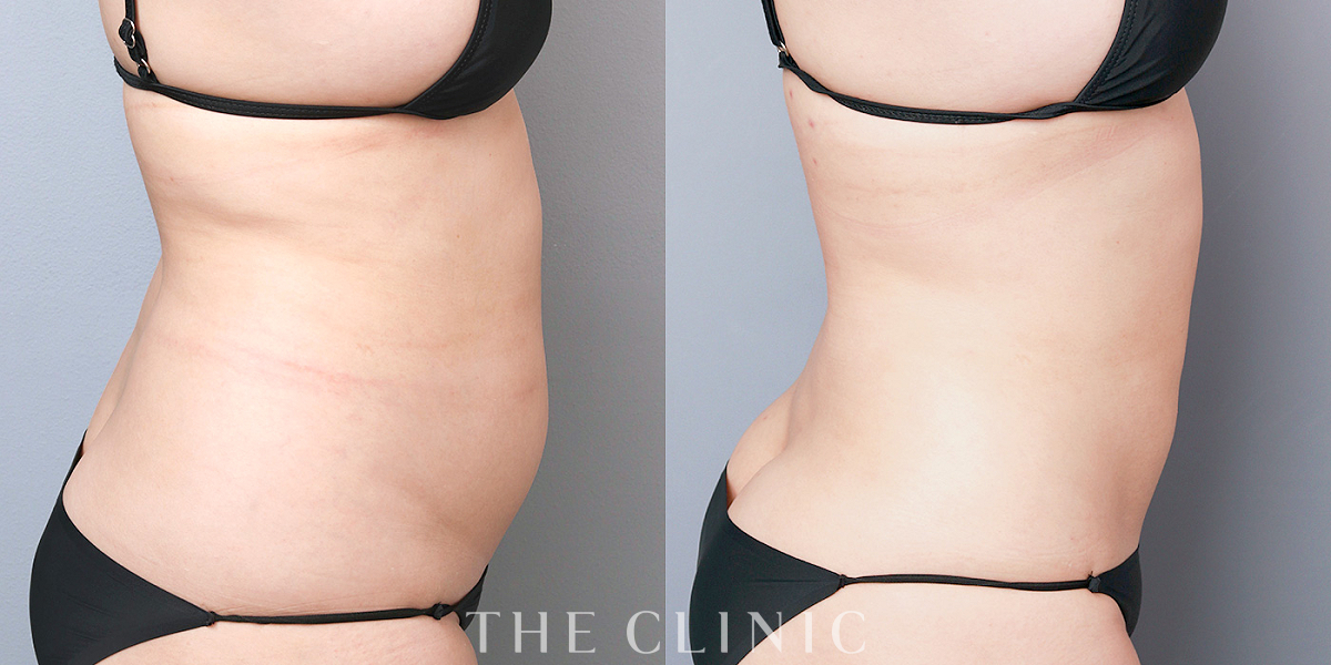 ベイザー脂肪吸引の術前/術後