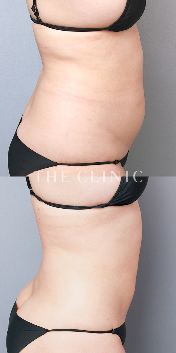 腰・ウエストのベイザー脂肪吸引（35歳女性）の術前・術後写真