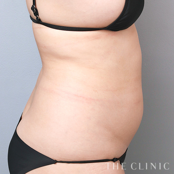 腰・ウエストのベイザー脂肪吸引（35歳女性）の術前写真