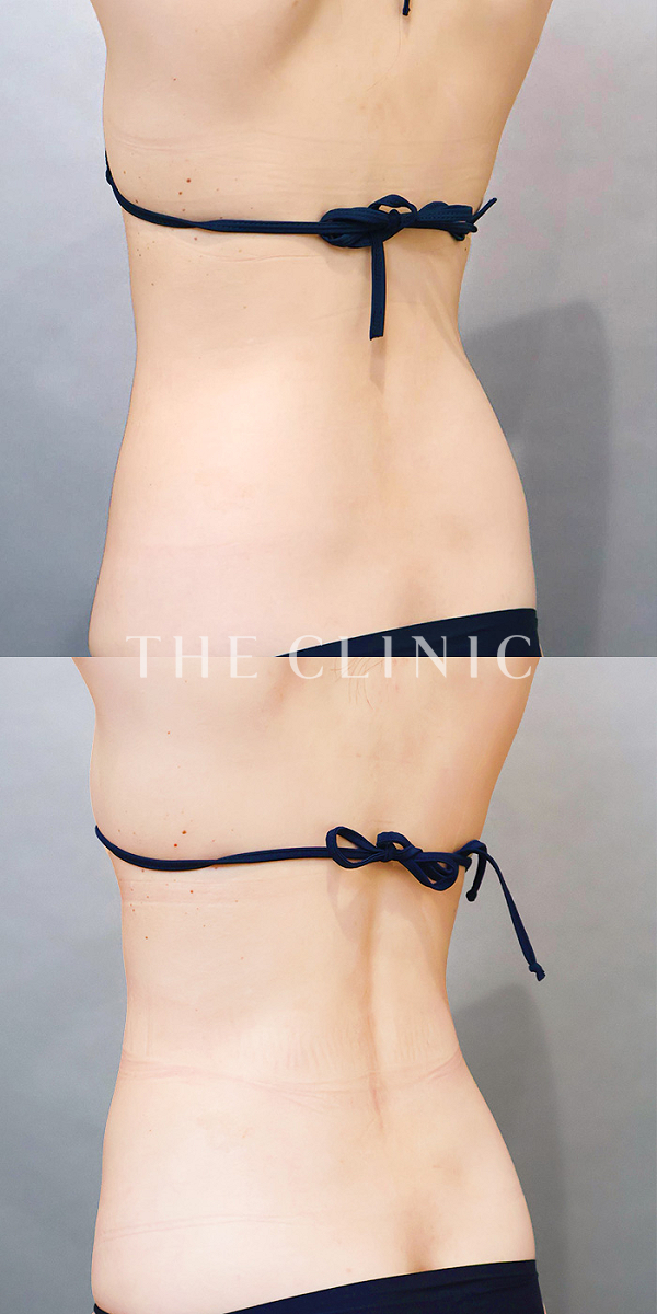 腰・ウエストのベイザー脂肪吸引（33歳女性）の術前・術後写真