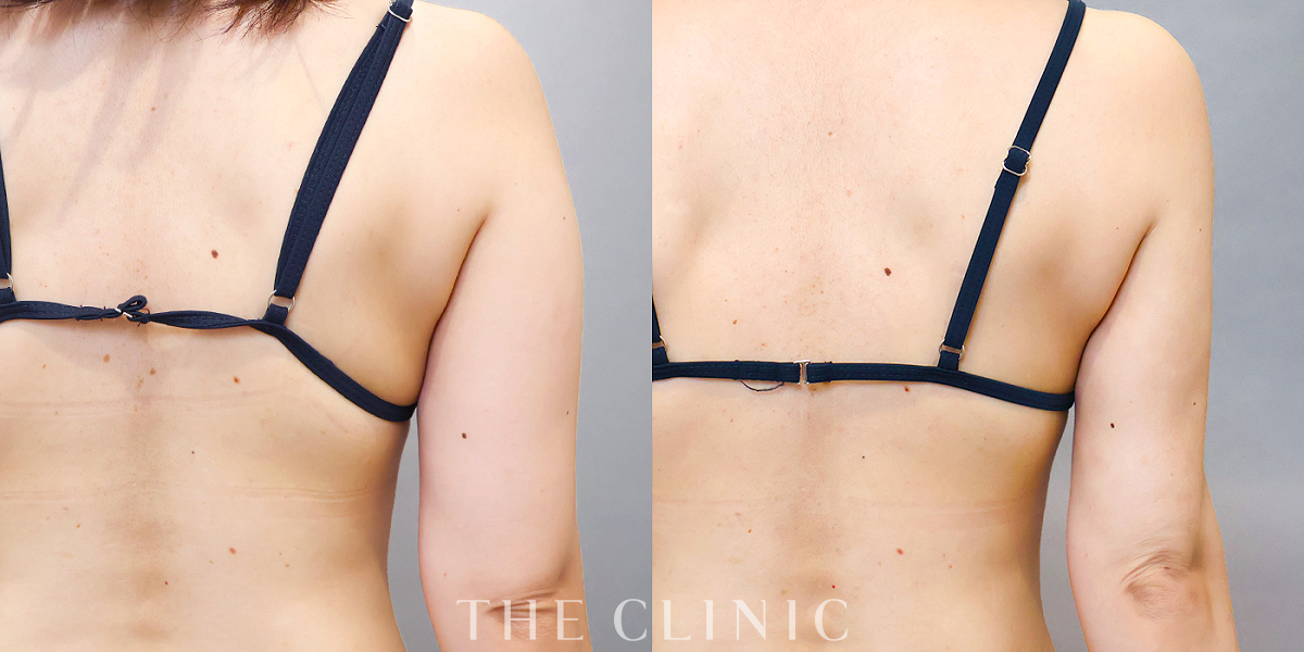 ベイザー脂肪吸引の術前/術後