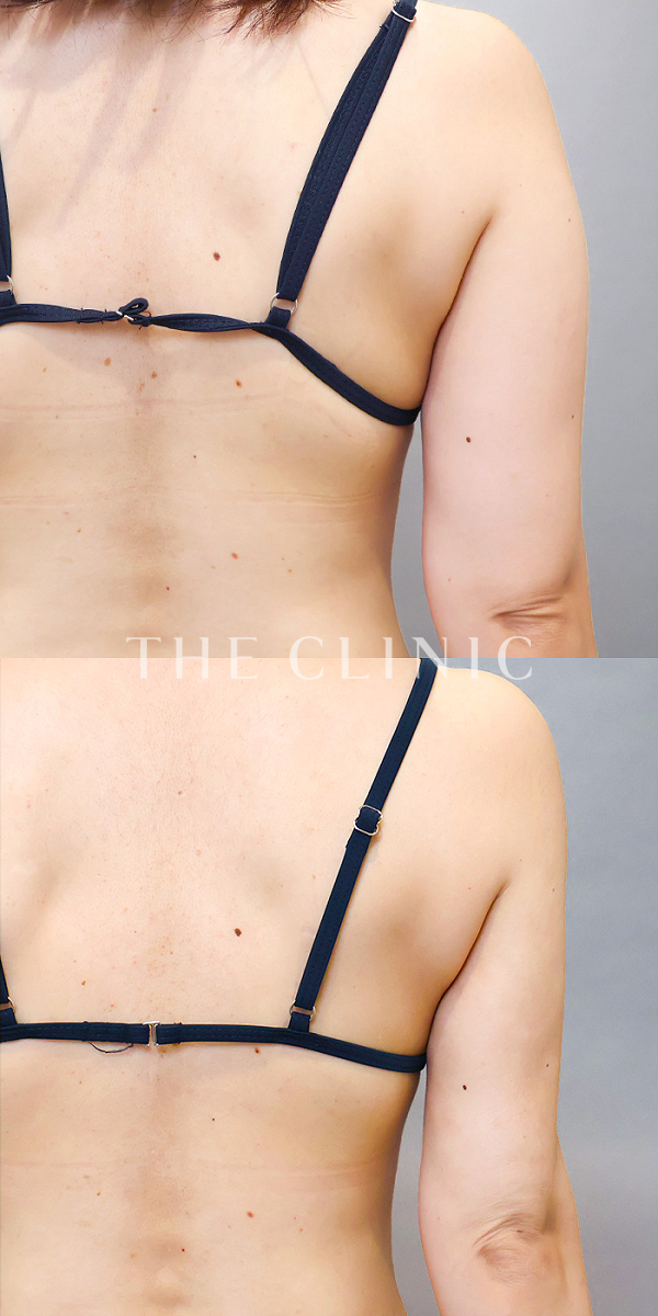 二の腕のベイザー脂肪吸引（40歳女性）の術前・術後写真