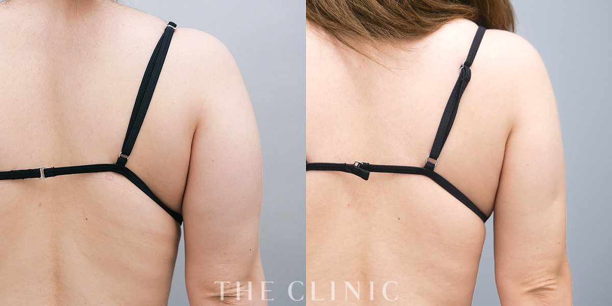 ベイザー脂肪吸引の術前/術後