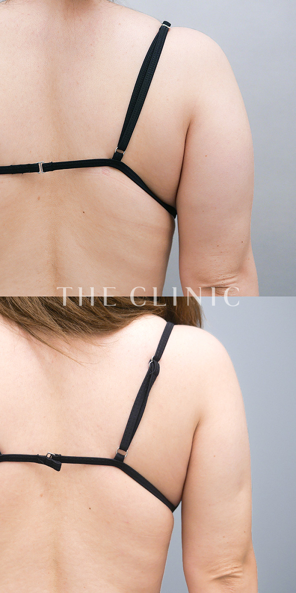 二の腕のベイザー脂肪吸引（31歳女性）の術前・術後写真