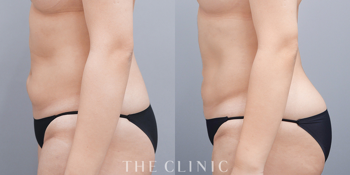 ベイザー脂肪吸引の術前/術後