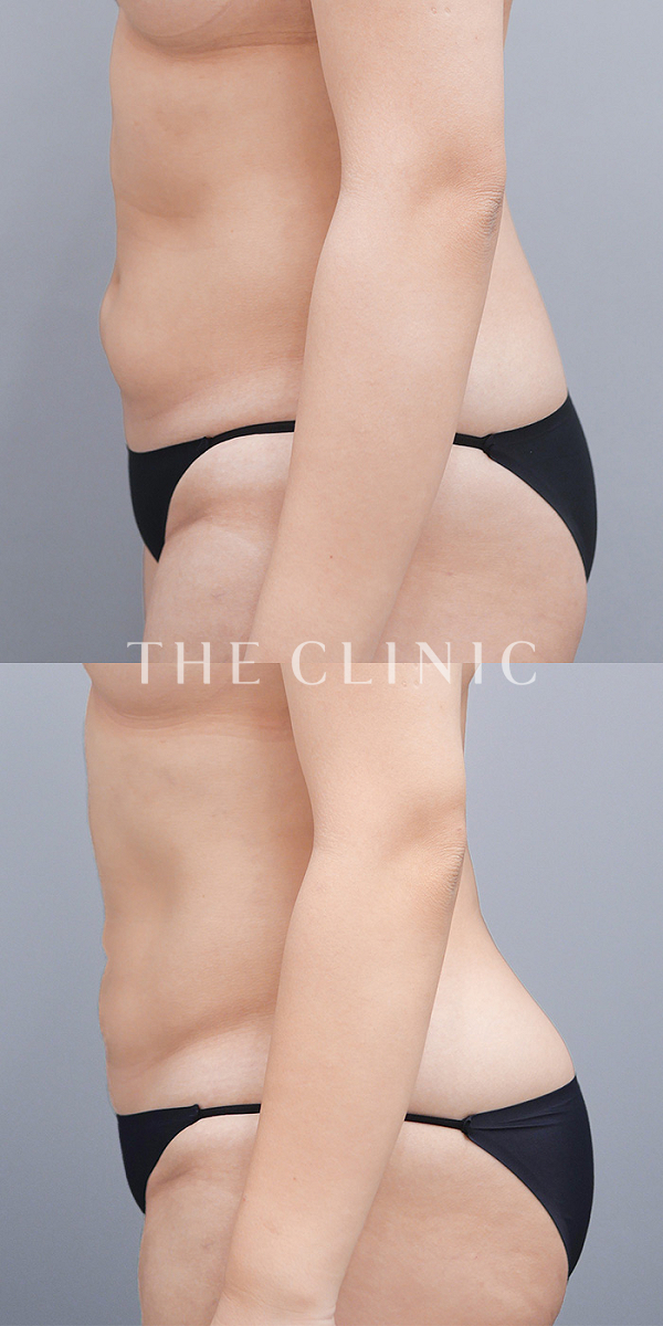 腹部のベイザー脂肪吸引（23歳女性）の術前・術後写真