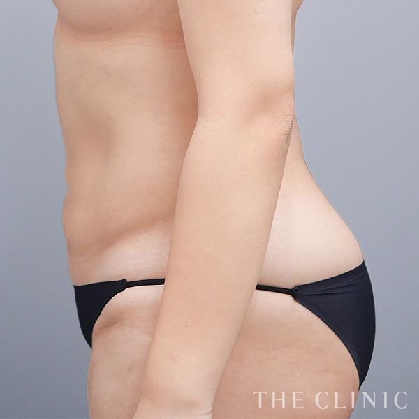 腹部のベイザー脂肪吸引（23歳女性）の術後写真