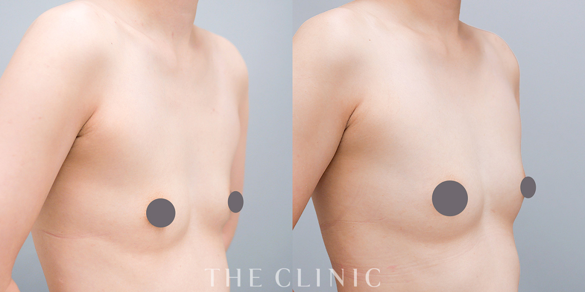 コンデンスリッチ豊胸の術前/術後