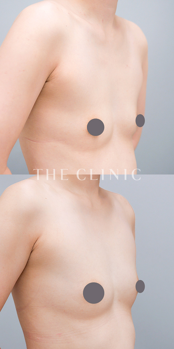 授乳後のたるみのコンデンスリッチ豊胸（35歳女性）の術前・術後写真