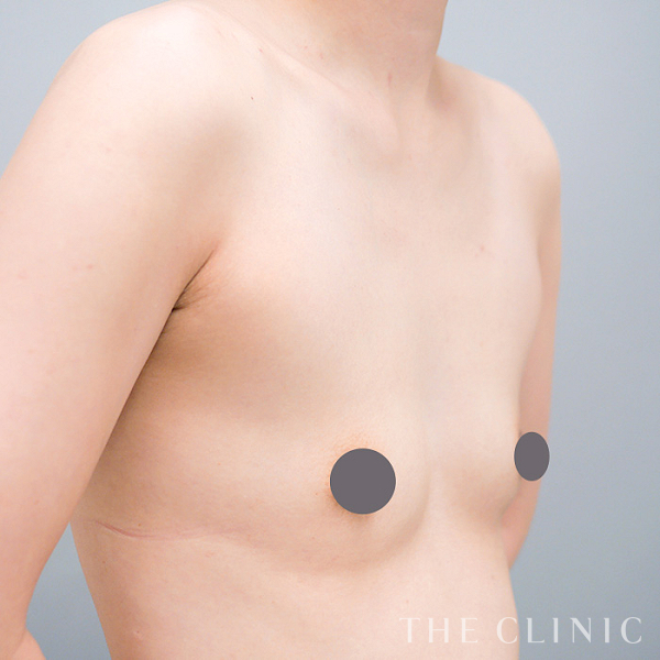 授乳後のたるみのコンデンスリッチ豊胸（35歳女性）の術前写真