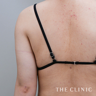 【THE CLINIC 症例画像】No.1551_2_二の腕_ベイザー脂肪吸引