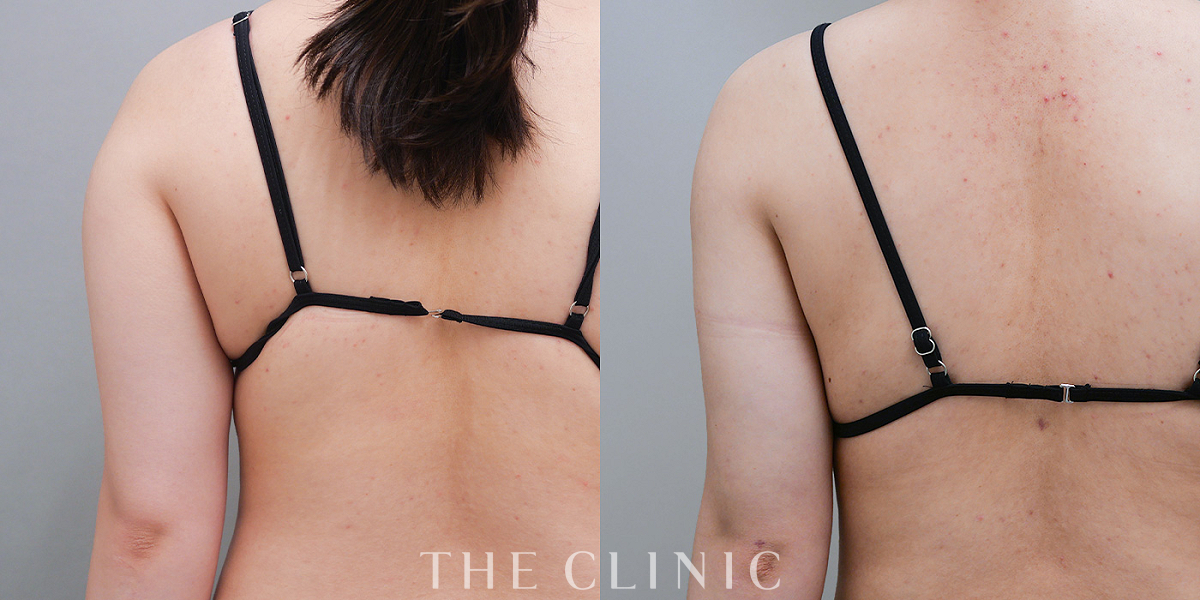 ベイザー脂肪吸引の術前/術後