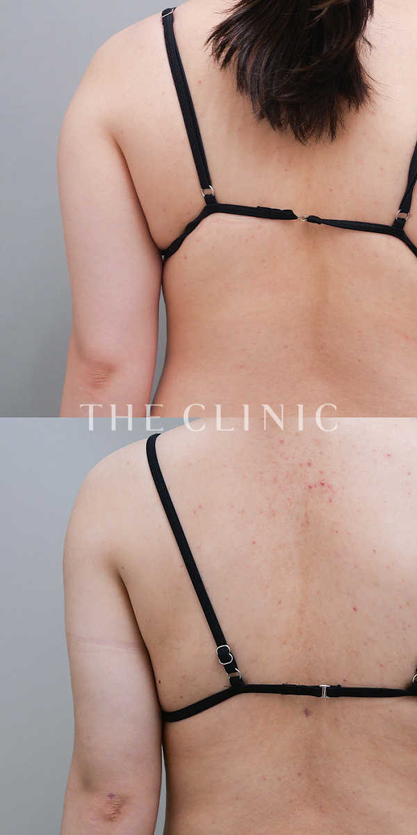 二の腕のベイザー脂肪吸引（27歳女性）の術前・術後写真