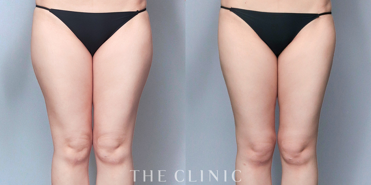 ベイザー脂肪吸引の術前/術後