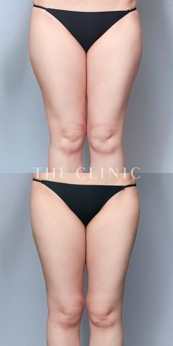 太もものベイザー脂肪吸引（31歳女性）の術前・術後写真