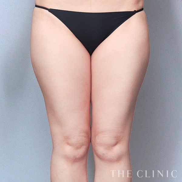 太もものベイザー脂肪吸引（31歳女性）の術前写真