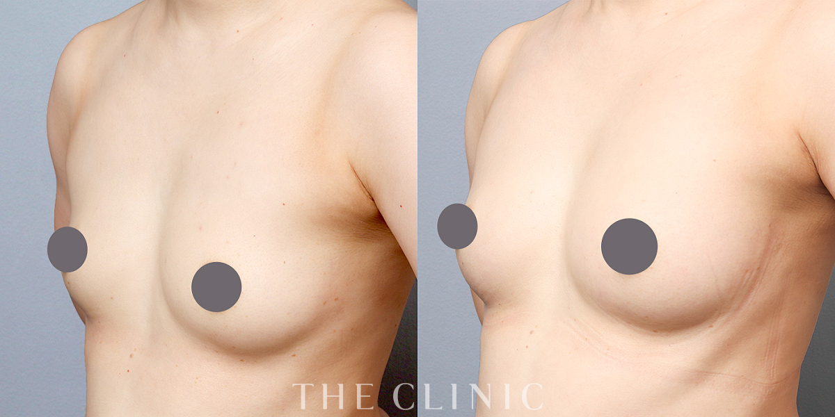 コンデンスリッチ豊胸の術前/術後