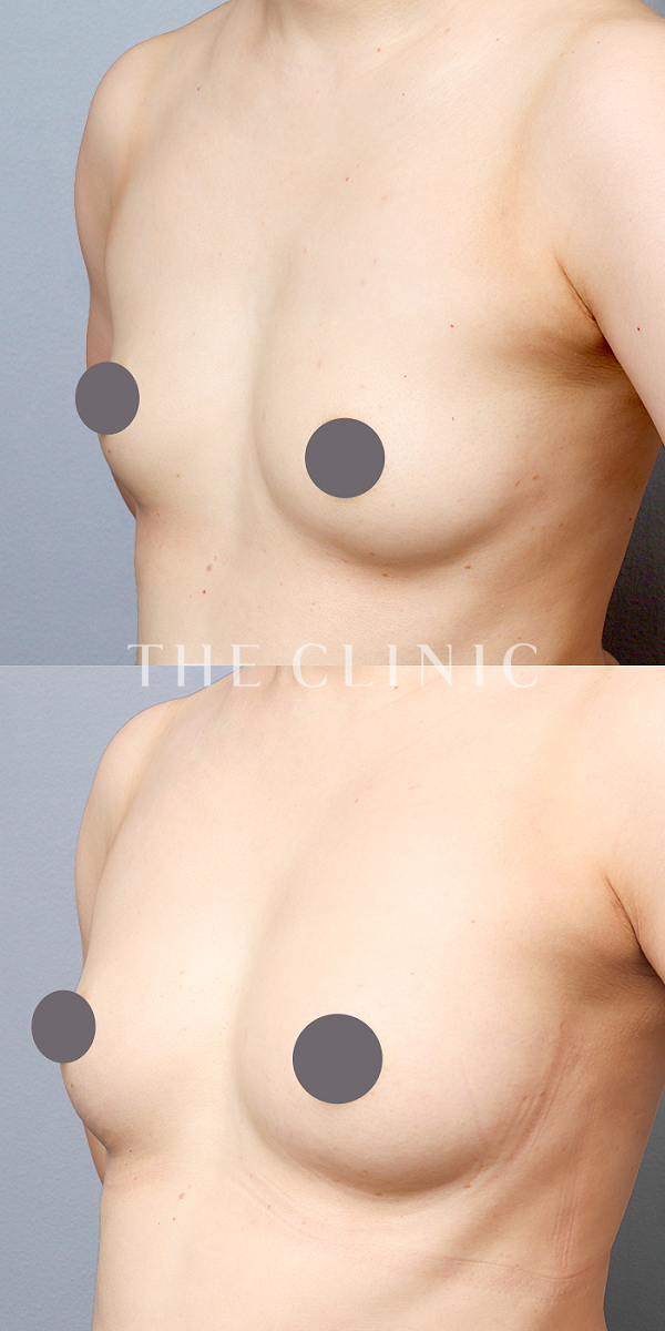 ボリュームアップのコンデンスリッチ豊胸（45歳女性）の術前・術後写真