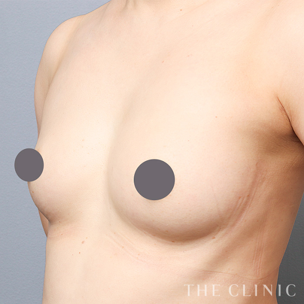 ボリュームアップのコンデンスリッチ豊胸（45歳女性）の術後写真