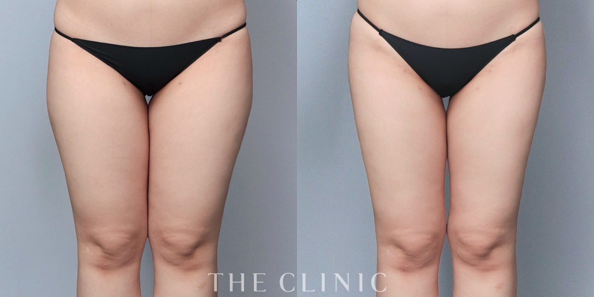 ベイザー脂肪吸引の術前/術後