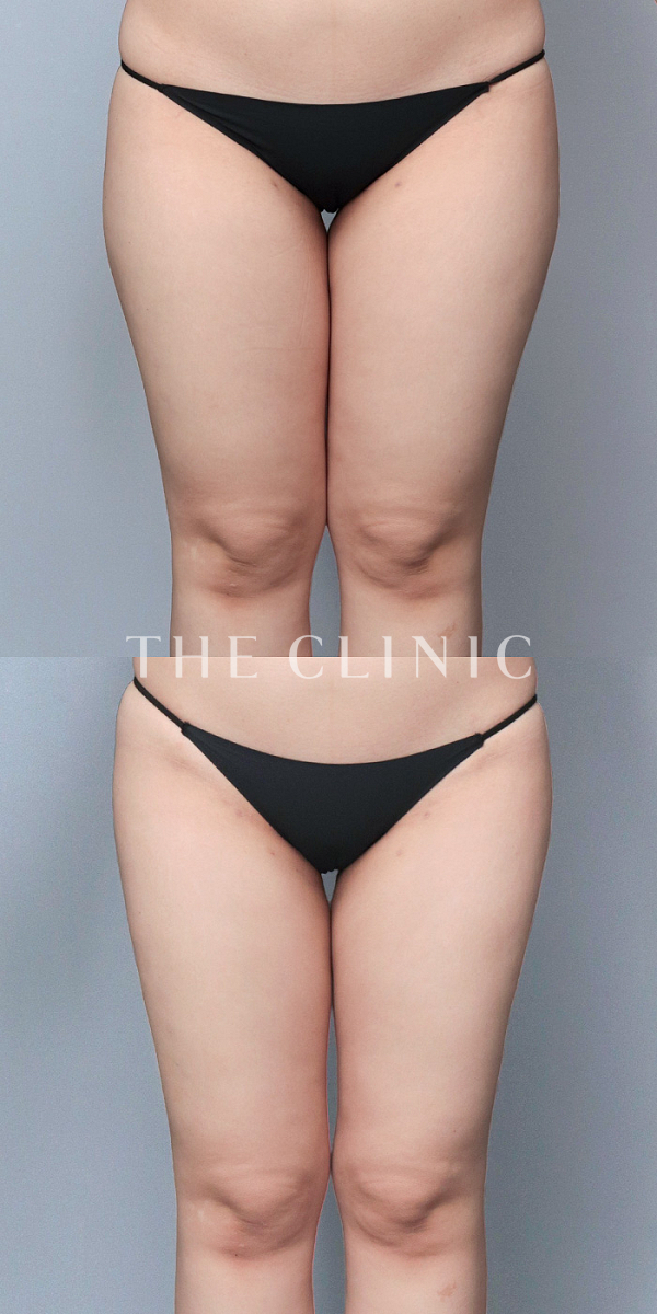 太もものベイザー脂肪吸引（24歳女性）の術前・術後写真