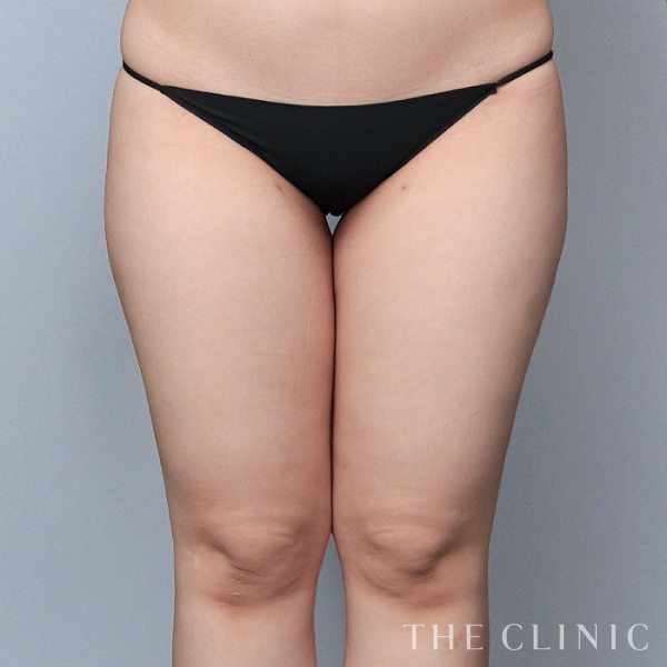 太もものベイザー脂肪吸引（24歳女性）の術前写真