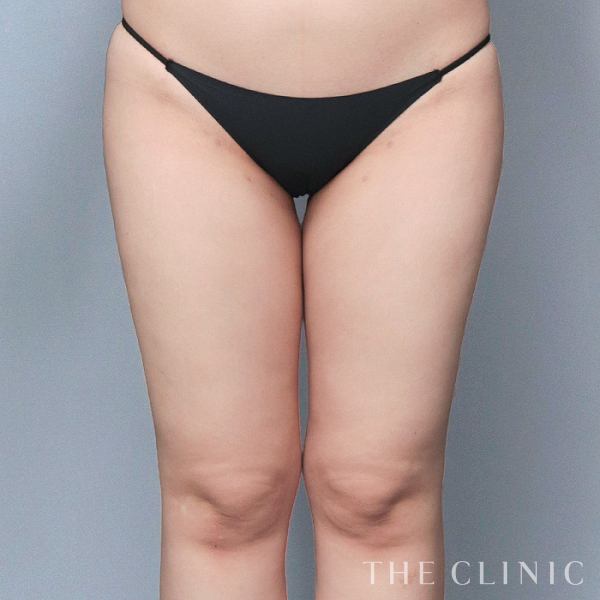 太もものベイザー脂肪吸引（24歳女性）の術後写真