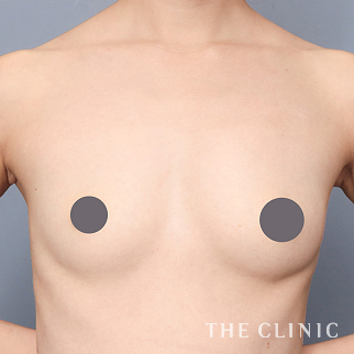 【THE CLINIC 症例画像】No.1555_1_ボリュームアップ_コンデンスリッチ豊胸