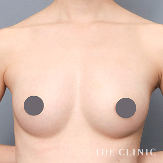 【THE CLINIC 症例画像】No.1555_2_ボリュームアップ_コンデンスリッチ豊胸