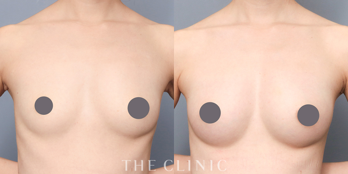 コンデンスリッチ豊胸の術前/術後