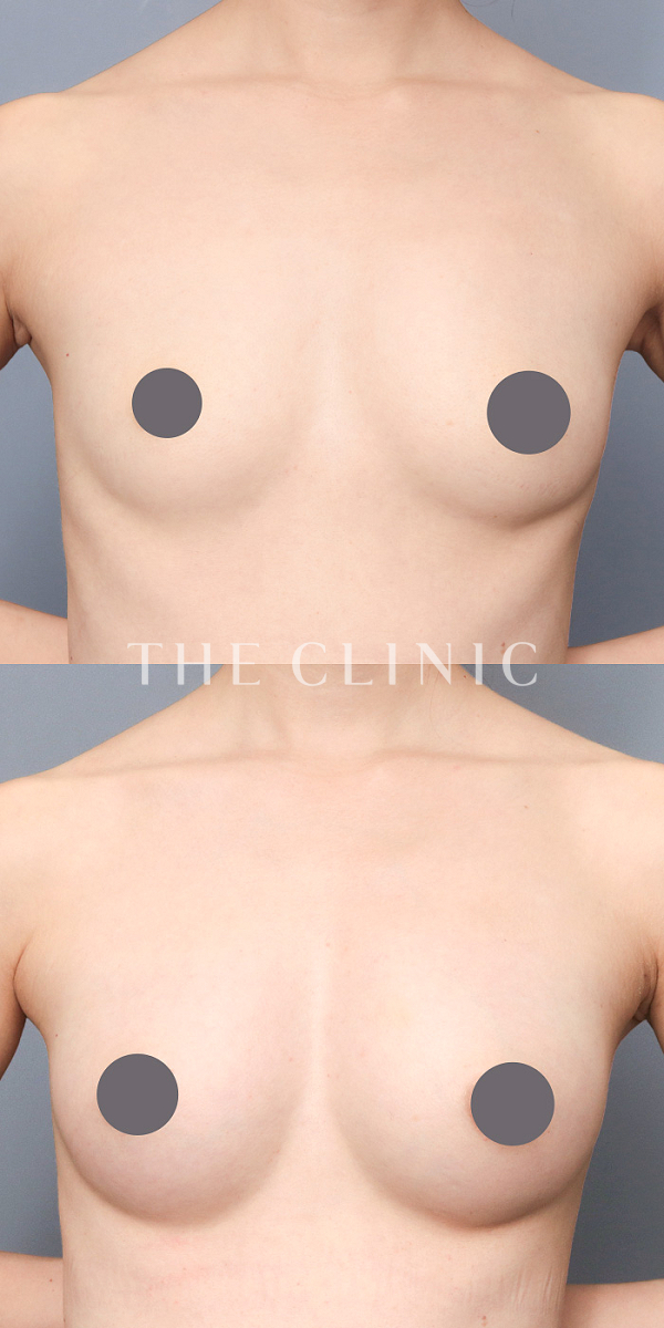 ボリュームアップのコンデンスリッチ豊胸（30歳女性）の術前・術後写真