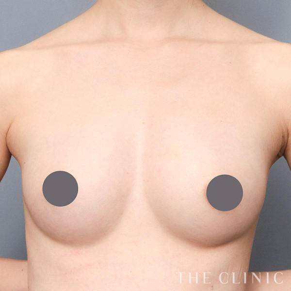 ボリュームアップのコンデンスリッチ豊胸（30歳女性）の術後写真