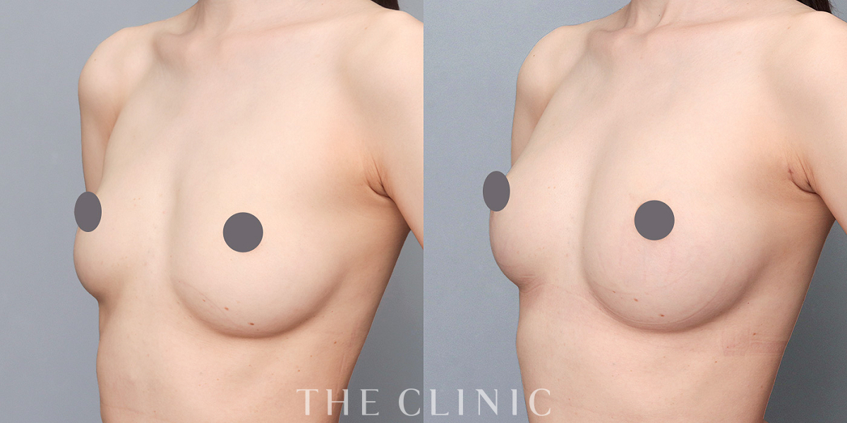 コンデンスリッチ豊胸の術前/術後