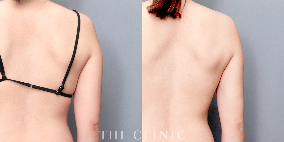 ベイザー脂肪吸引の術前/術後