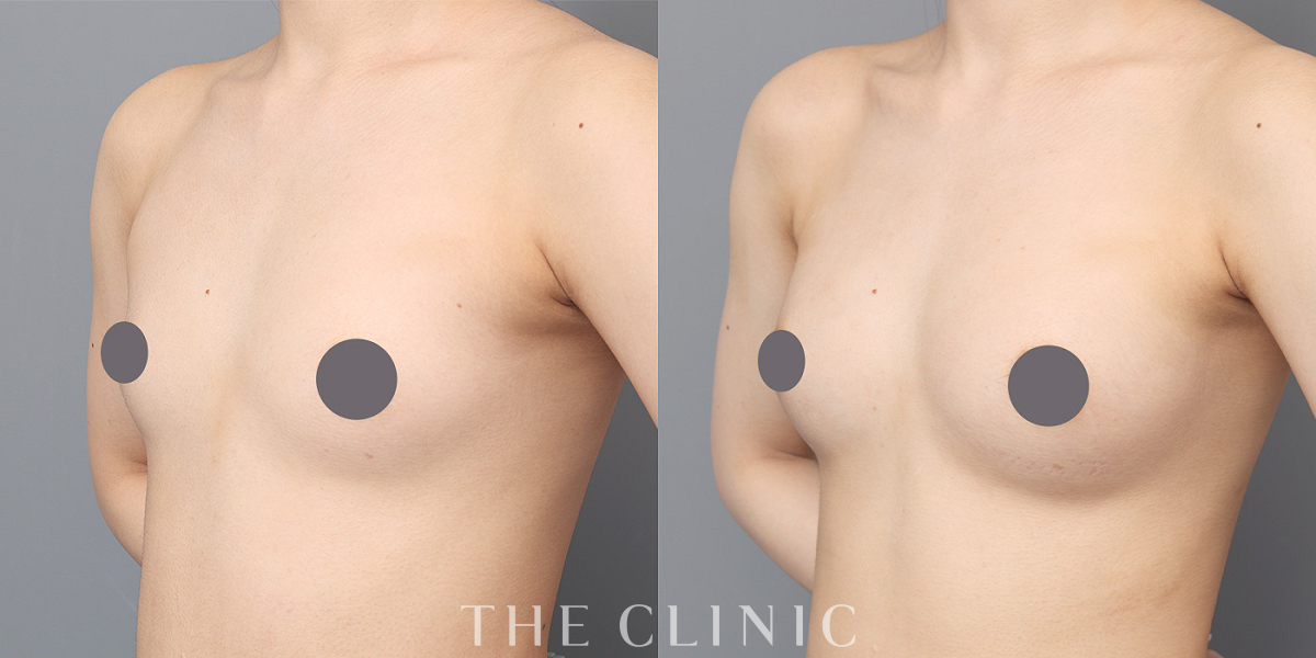 コンデンスリッチ豊胸の術前/術後