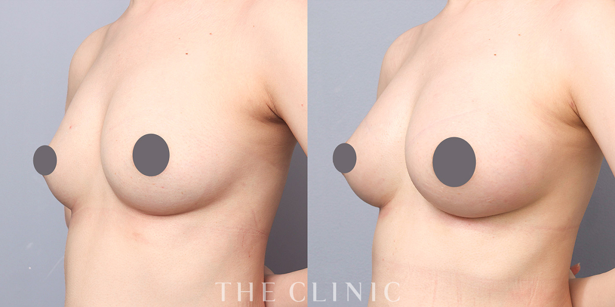 コンデンスリッチ豊胸の術前/術後