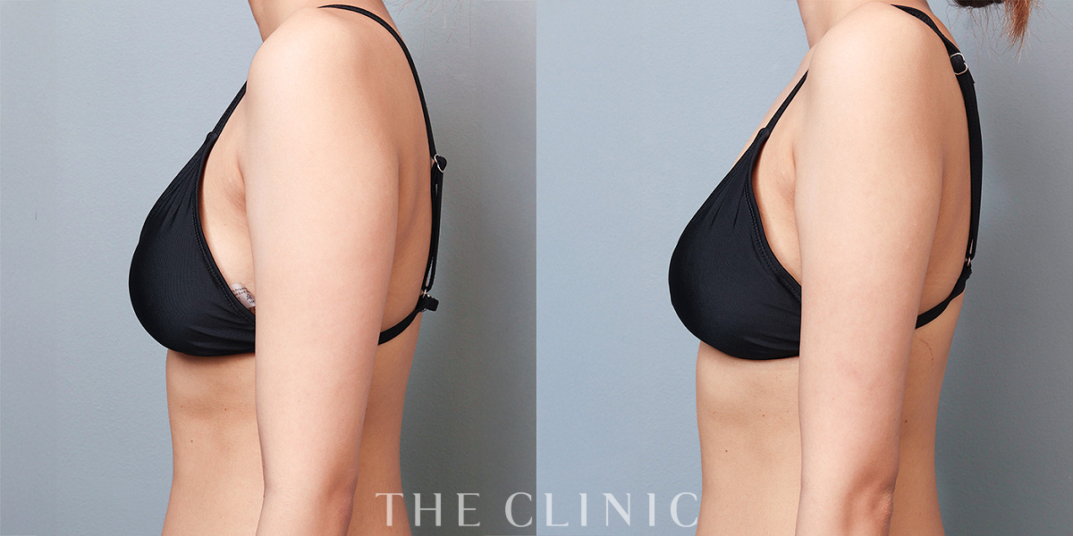 ベイザー脂肪吸引の術前/術後