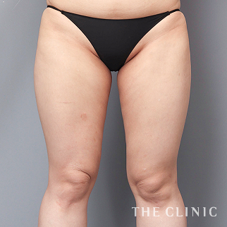 【THE CLINIC 症例画像】No.1561_1_太もも_360脂肪吸引®